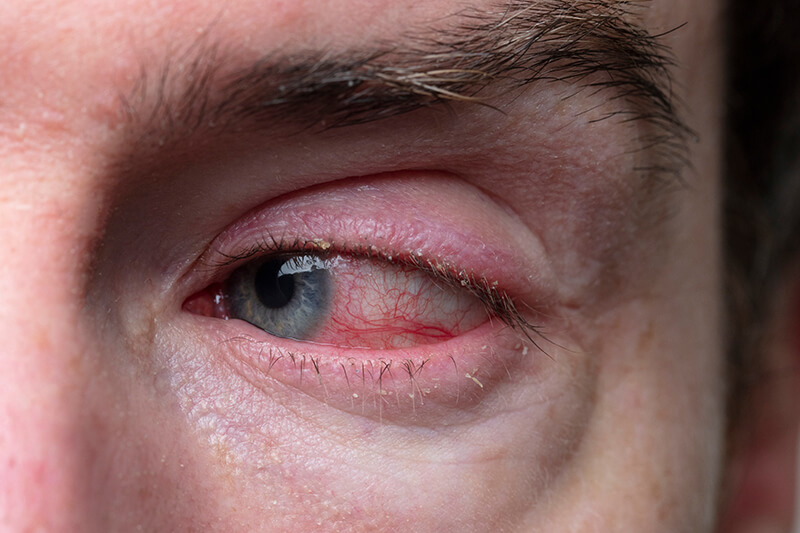 Man Experiencing Blepharitis in the Eye