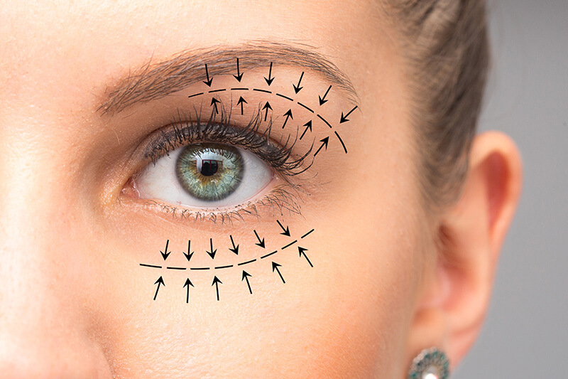 Woman Being Prepped For Blepharoplasty Surgery