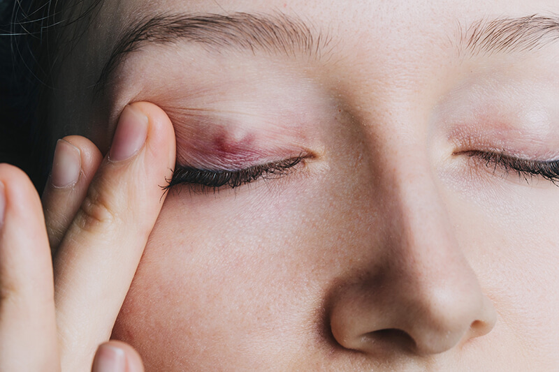 Chalazion on an Eyelid