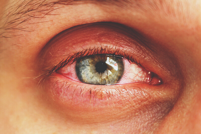 Conjunctivitis in an Eye