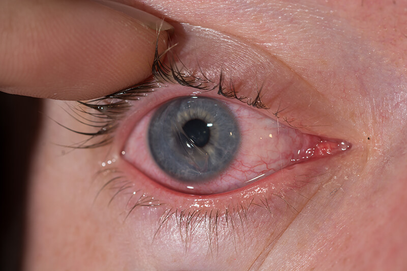 Closeup of an Eye Getting Checked For a Corneal Abrasion