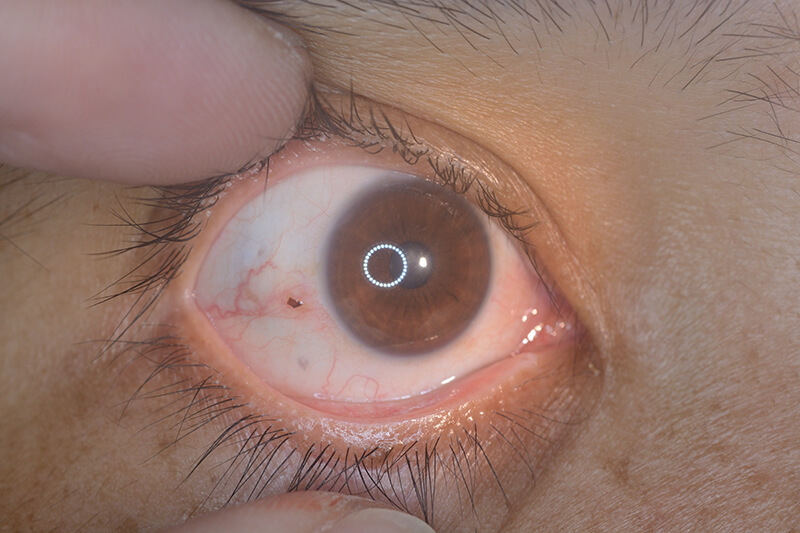 Corneal Foreign Body