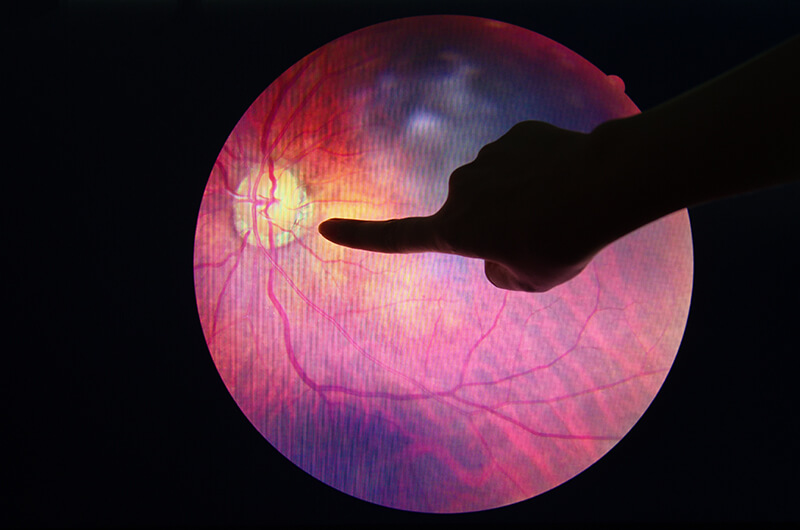 Diabetic Eye Scan