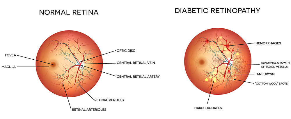 Chart Illustrating a Normal Retina vs One With Diabetic Retinopathy