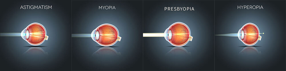 Chart Illustrating How Astigmatism, Myopia, Presbyopia and Hyperopia Affect an Eye