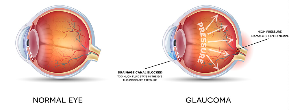 Chart Illustrating a Normal Eye Compared to One Experiencing Glaucoma