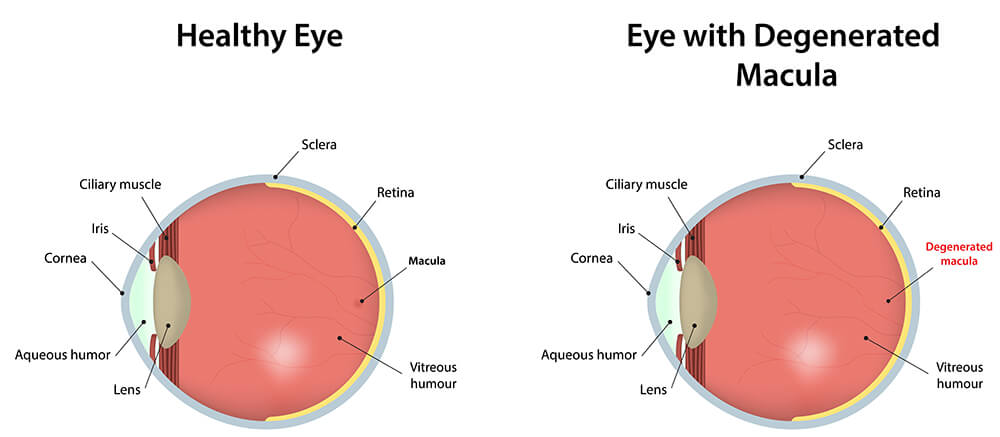 Chart Illustrating a Healthy Eye Compared to One With a Degenerated Macula
