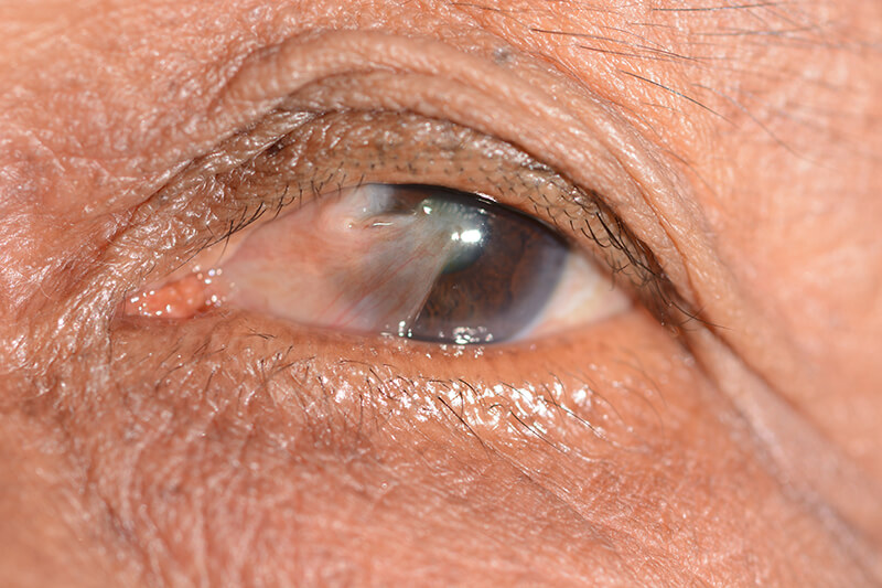 Pterygium in an Eye