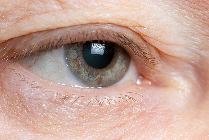 Eye Experiencing Ptosis