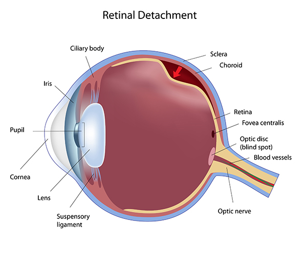 retinal detachment chart