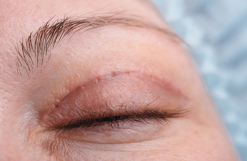 Patient that Just Had an Upper Blepharoplasty
